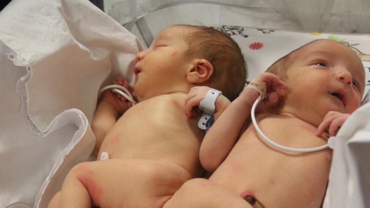 Siyam İkizlerini Ölüm Ayırdı